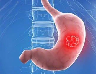 你知道嗎？從慢性胃炎到胃癌，只有四步！